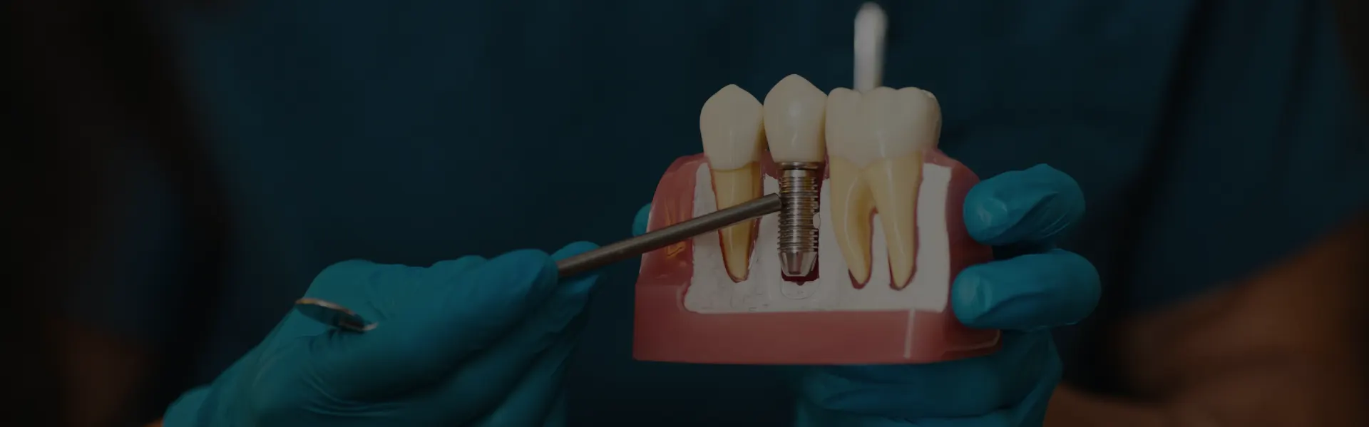 Dentist pointing to a dental implant on a model
