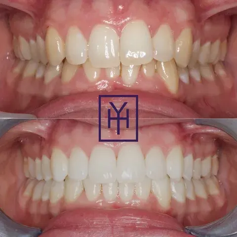 Before and after Invisalign treatment at York House