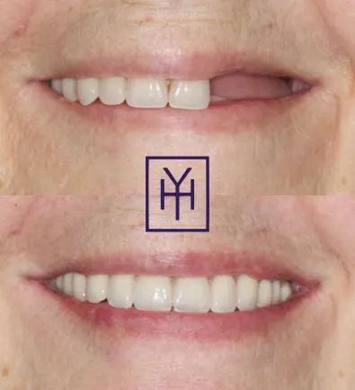 Before and after: dental implant case