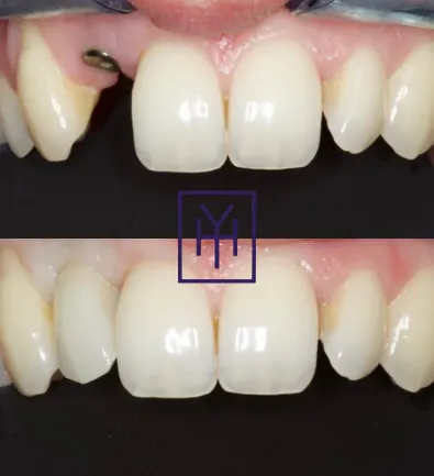 Before and after: dental implant case