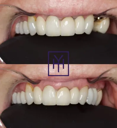 Before and after: dental implant case