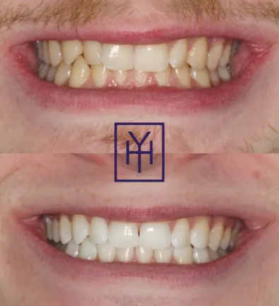 Before and after: Invisalign case