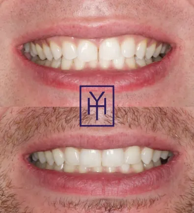 Before and after: Invisalign case