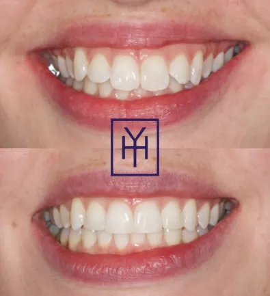 Before and after: Invisalign case