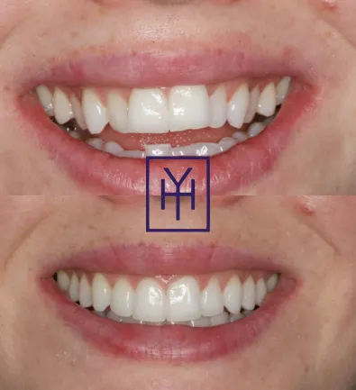 Before and after: Invisalign case