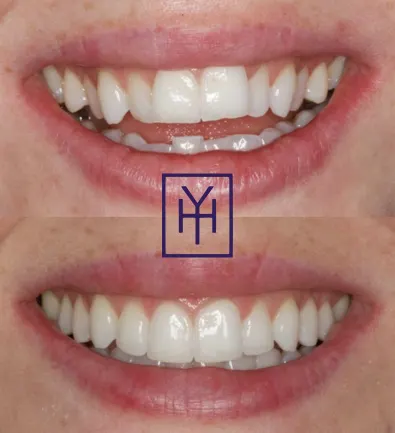 Before and after: Invisalign case