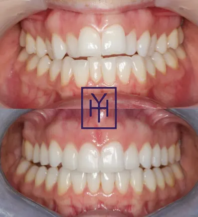 Before and after: Invisalign case