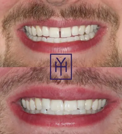 Before and after: veneers case
