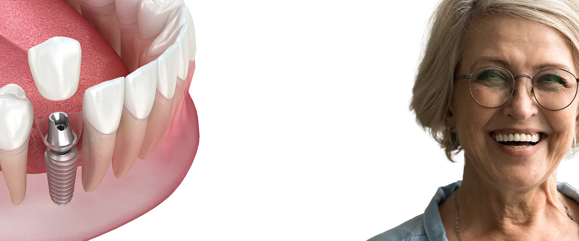 Invisalign Hero
