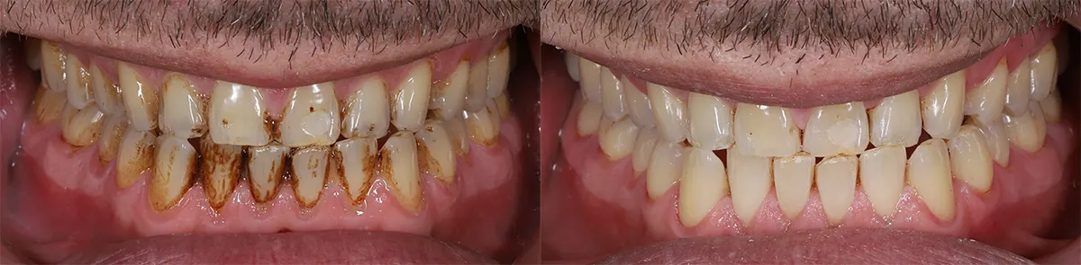 Before and after air polishing: stained teeth, and the same teeth after cleaning