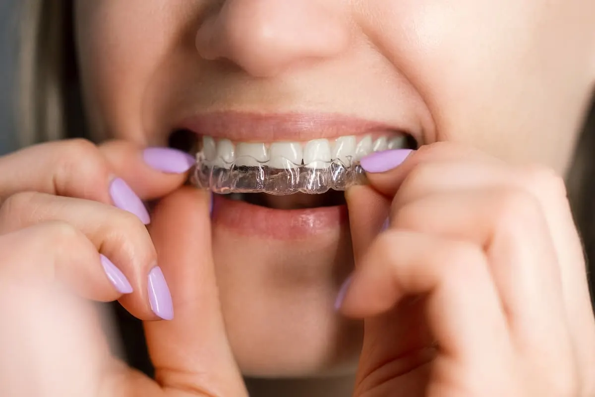 Woman fitting a clear aligner over her teeth