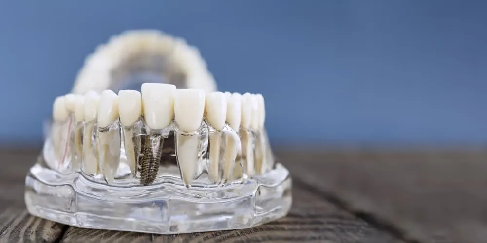 Dental Implant Surgery