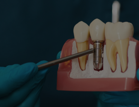 Dental Implants in Little Chalfont: Your Complete Guide to Tooth Replacement