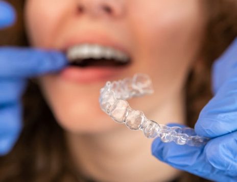 Top Benefits of Choosing Invisalign Over Metal Braces
