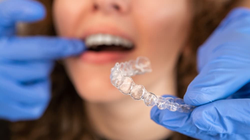 Benefits of Choosing Invisalign