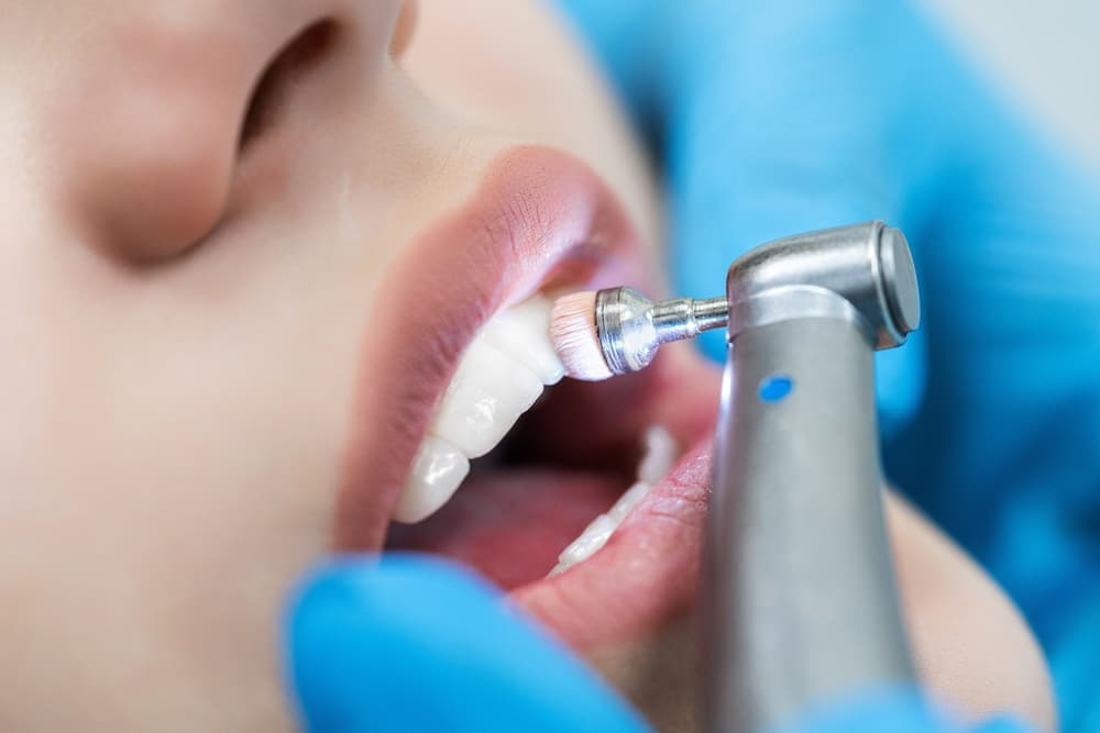 Teeth Cleaning in Chesham