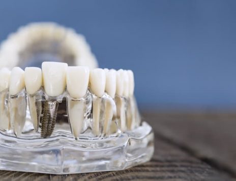 What to Expect Before, During, and After Your Dental Implant Surgery